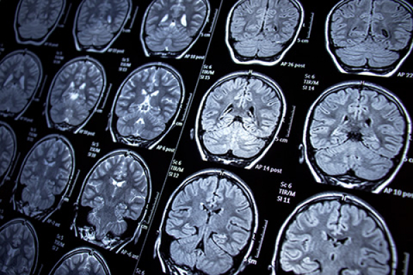 UNIB estudia cómo el Alzheimer afecta el cerebro mediante enfoques de aprendizaje automático 