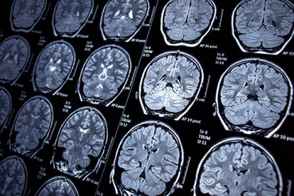 UNIB estudia cómo el Alzheimer afecta el cerebro mediante enfoques de aprendizaje automático